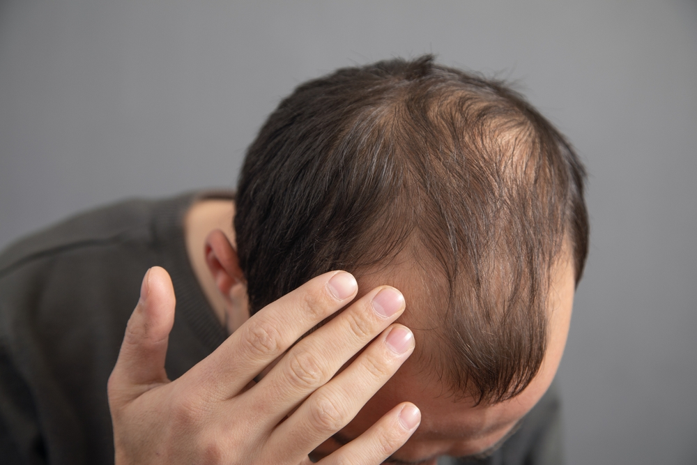 Understanding The Causes A Comprehensive Guide To Hair Loss